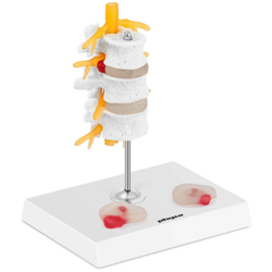 Modello Anatomico Ernia Del Disco Lombare Colorato Con Base Di Sostegno Plastica características