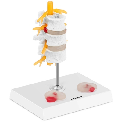 Modello Anatomico Ernia Del Disco Lombare Colorato Con Base Di Sostegno Plastica